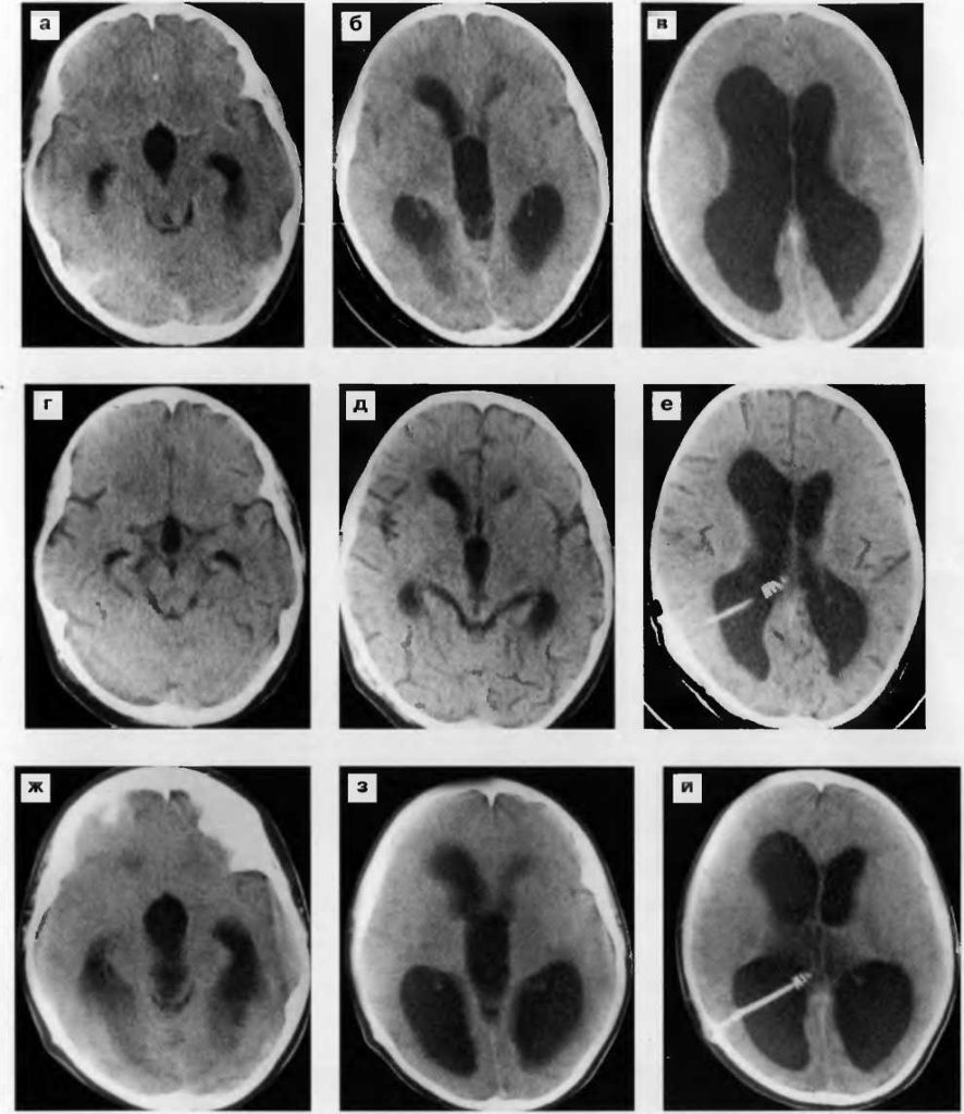 Признаки умеренно выраженная гидроцефалия